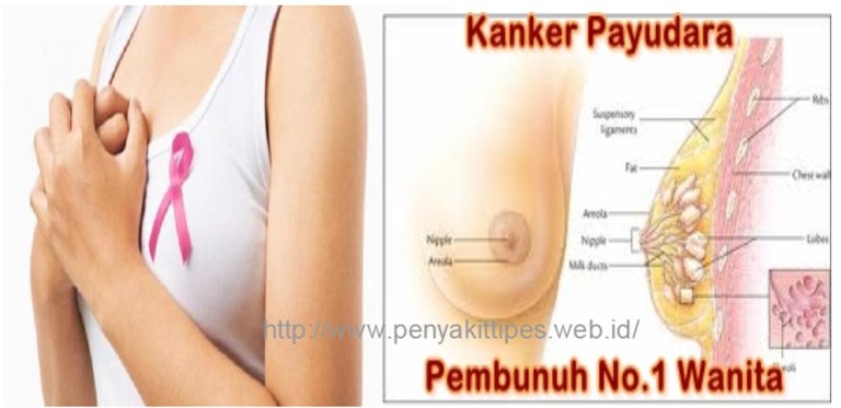 penyakit-kanker-payudara.jpg