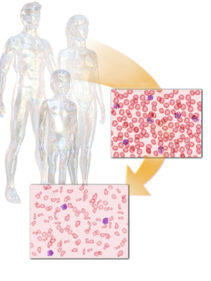 Thalassemia