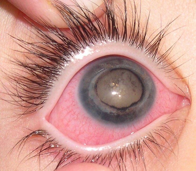 https://commons.wikimedia.org/wiki/File:Eye_of_patient_with_Coats%27_disease