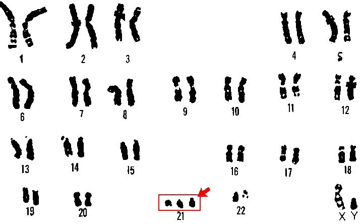 21 trisomy - Down syndrome