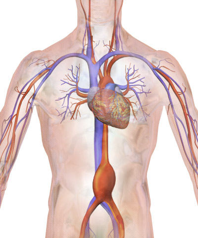 Simplified Explanation of Abdominal Aortic Aneurysm