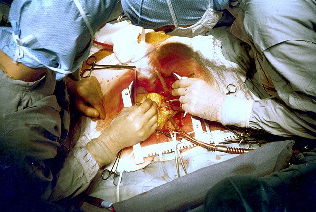 Coronary artery bypass surgery during mobilization (freeing) of the right coronary artery from its surrounding tissue, adipose tissue (yellow). The tube visible at the bottom is the aortic cannula (returns blood from the HLM)
