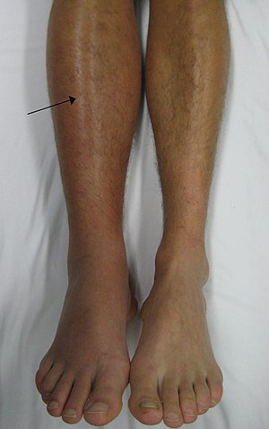 Deep vein thrombosis/ right leg