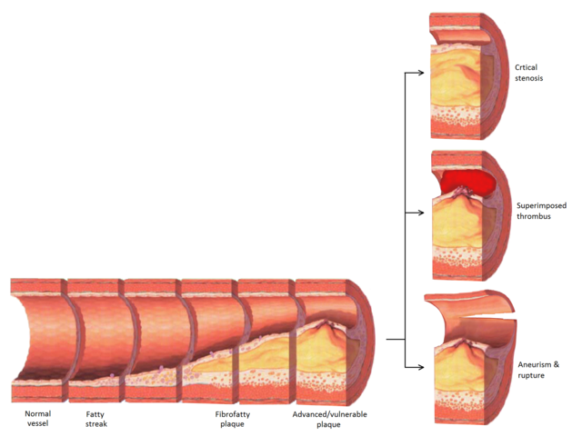 Progression of atherosclerosis to late complications
