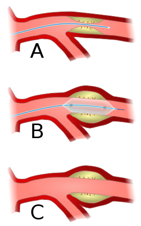 Angioplasty.