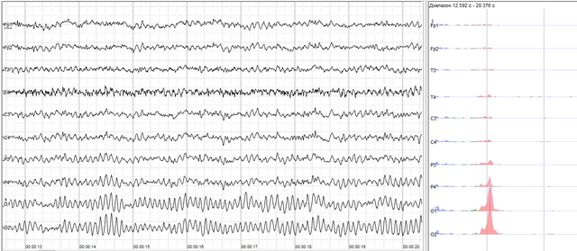 Human EEG with prominent resting state activity – alpha-rhythm. Left: EEG traces (horizontal – time in seconds; vertical – amplitudes, scale 100 μV). Right: power spectra of shown signals (vertical lines – 10 and 20 Hz, scale is linear). Alpha-rhythm consists of sinusoidal-like waves with frequencies in 8–12 Hz range (11 Hz in this case) more prominent in posterior sites. Alpha range is red at power spectrum graph.