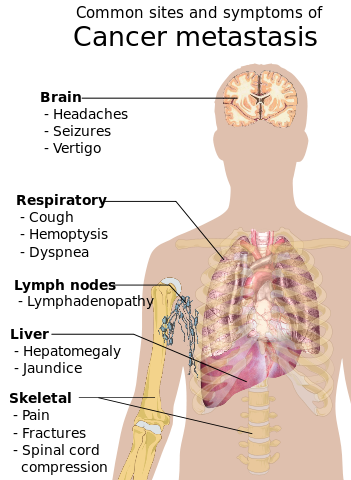 Symptoms of cancer metastasis depend on the location of the tumor.