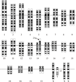 Down syndrome translocation up