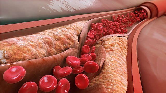 Narrowed arterial blood vessel blocked with an anteroma.