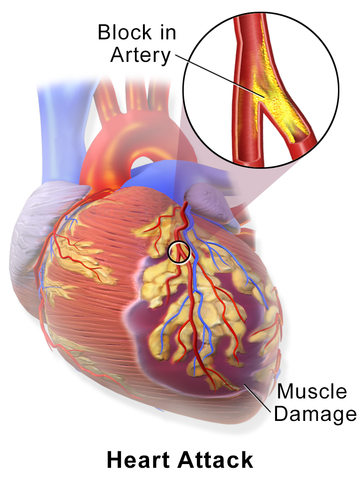 Myocardial Infarction or Heart Attack