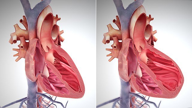 Model of a normal heart, with contracted muscle (left); and a weakened heart, with over-stretched muscle (right)