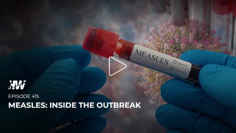 Episode 415 - Measles - Inside The Outbreak