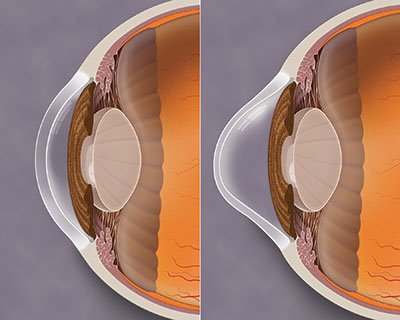 Normal-cornea-and-keratoconus-cornea_web.jpg