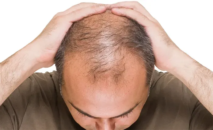 নতুন চুল গজানোর একমাত্র ঔষধ 