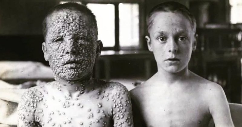 Fun Facts About Smallpox: Mummies, Human Trafficking, and Benjamin Franklin