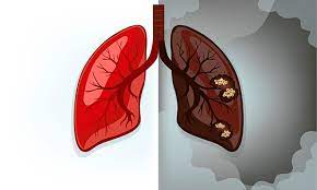 pulmones de cancer.jpg