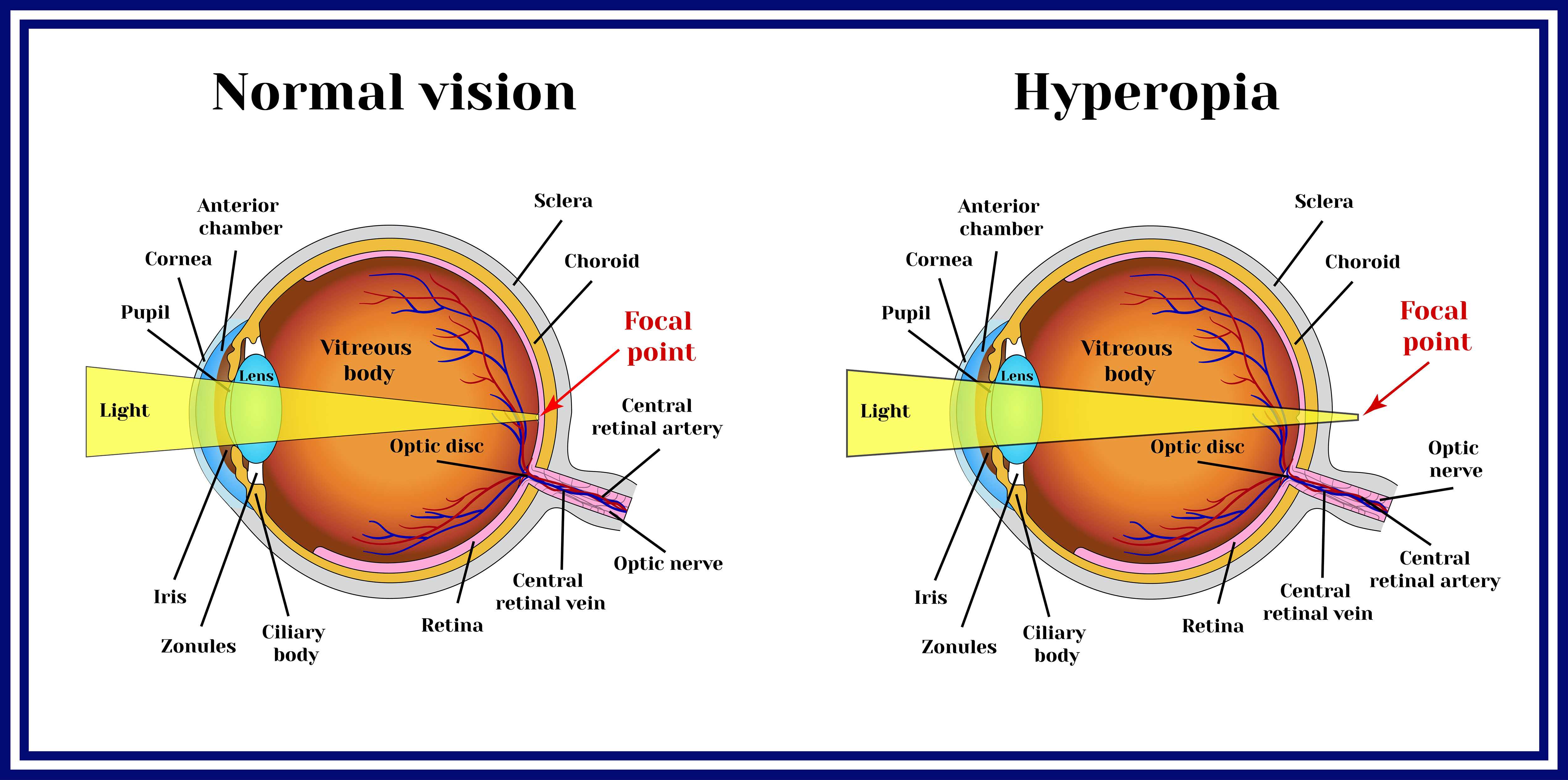 hyperopia-large__5000x2489.jpg