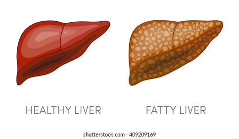 fatty-liver-disease-vector-illustration-260nw-409209169.webp