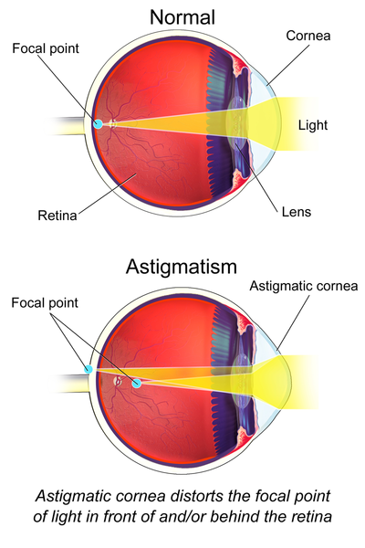 Astigmatism_(Eye).png