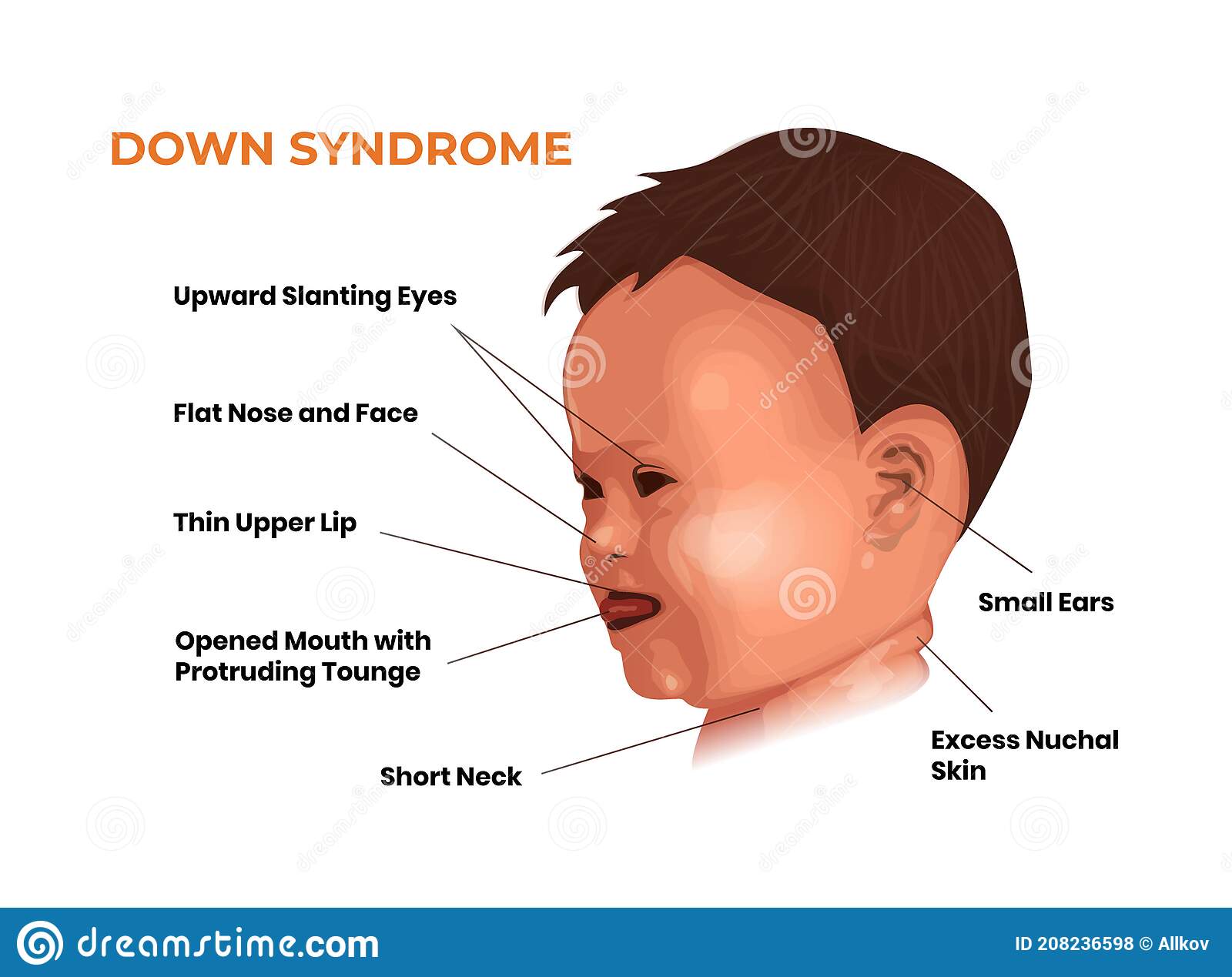 características-faciales-del-bebé-con-síndrome-de-down-trisomía-síntomas-ilustración-sonriente-diown-208236598.jpg