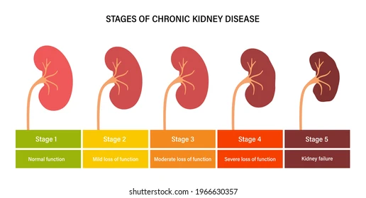 kidney-disease-vector-illustration-stages-260nw-1966630357.webp