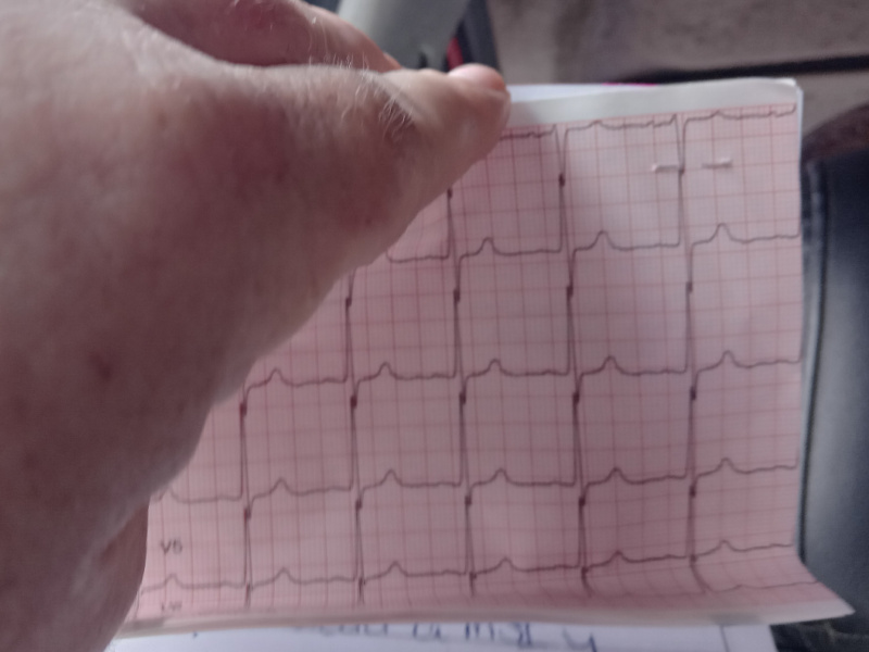 NSTEMI ecg.jpg