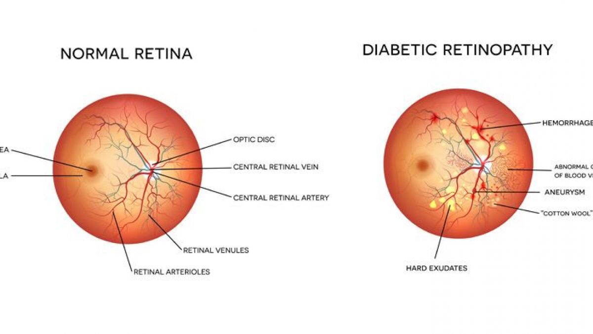 diabetic-rethonopaty-1200x675.jpg