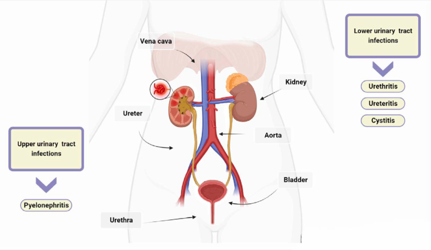 Urinary-tract-infections-UTIs-UTIs-are-classified-as-upper-or-lower-based-on-their.png