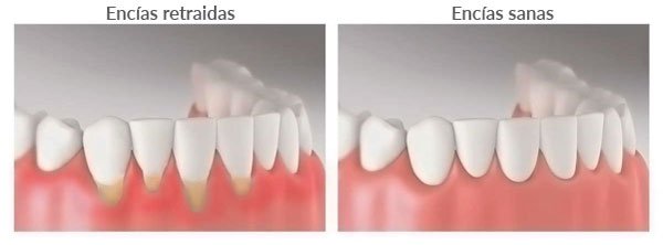 encias-retraidas-tratamiento.jpg