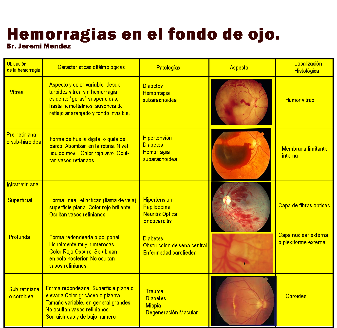 Hemorragias fondo de ojo.1.jpg