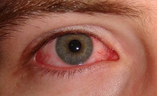 Conjunctivitis.webp