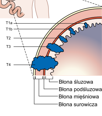 Diagram_showing_the_T_stages_of_stomach_cancer_CRUK_374_pl.png