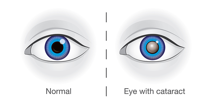 Eye-Cataract.jpg