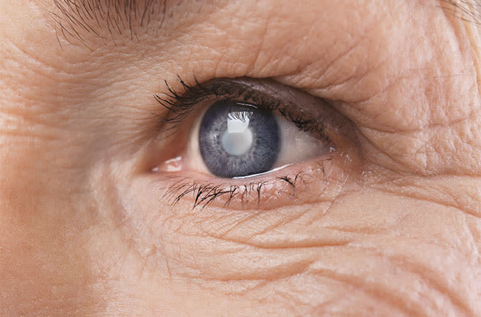 cataract-closeup-hero.jpg