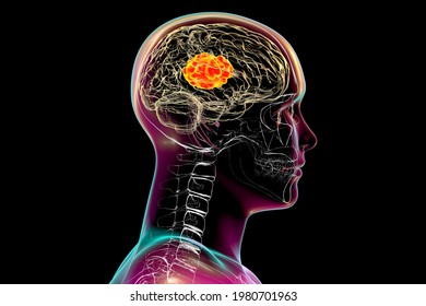 brain-mucormycosis-lesion-caused-by-260nw-1980701963.jpg