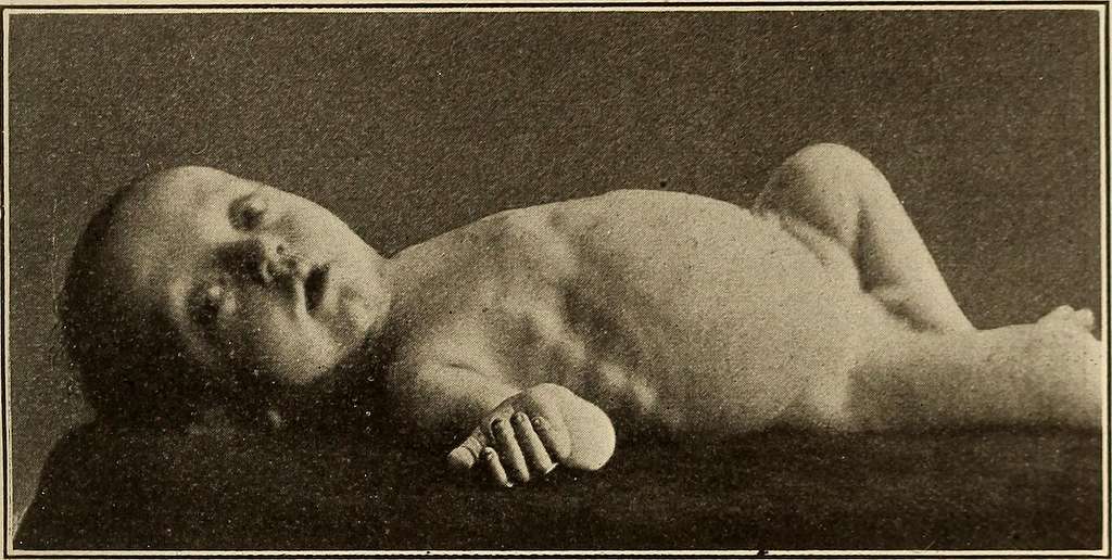 diseases-of-infancy-and-childhood-1914-14748982096-b12060-1024.jpg