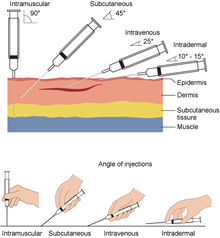 Needleinsertionangles1.png