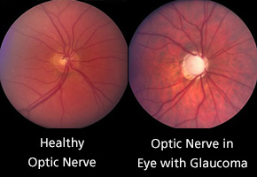 optic-nerve-comparison_290.jpg