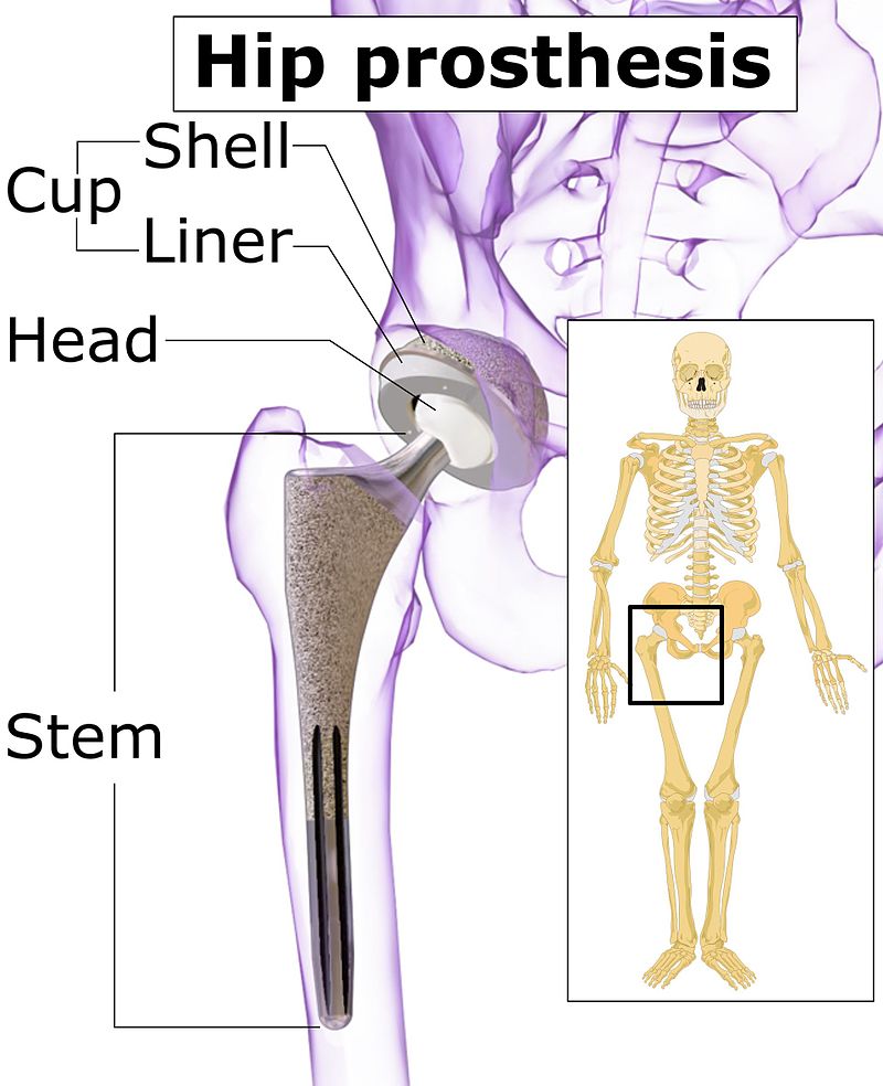 Hip_prosthesis_components.jpg