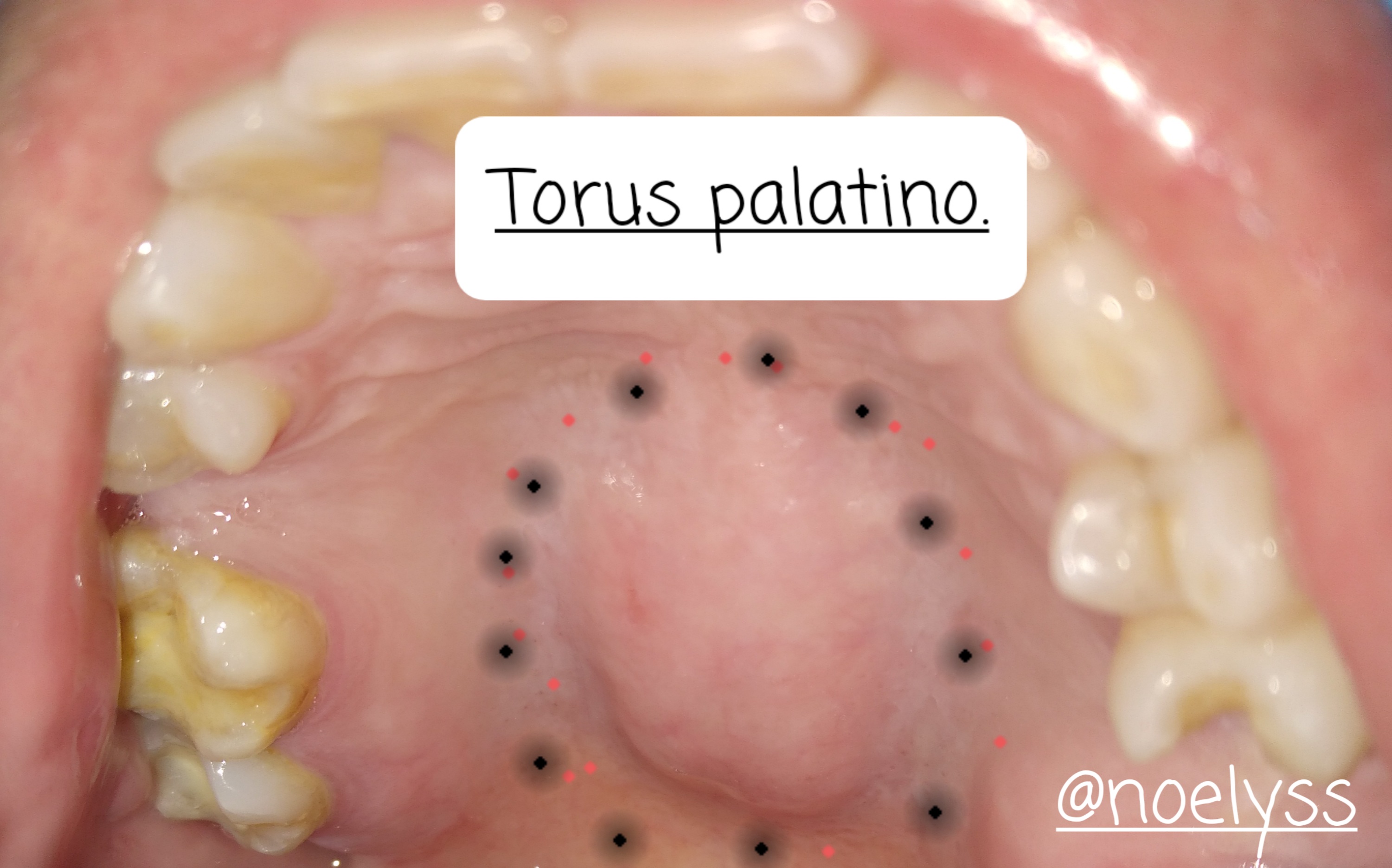 Let's talk about palatal torus. Hablemos del torus palatino. — Hive