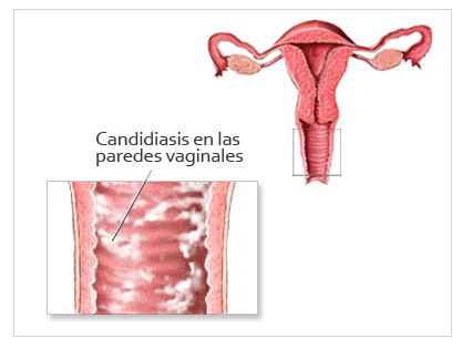 candidiasis.jpg