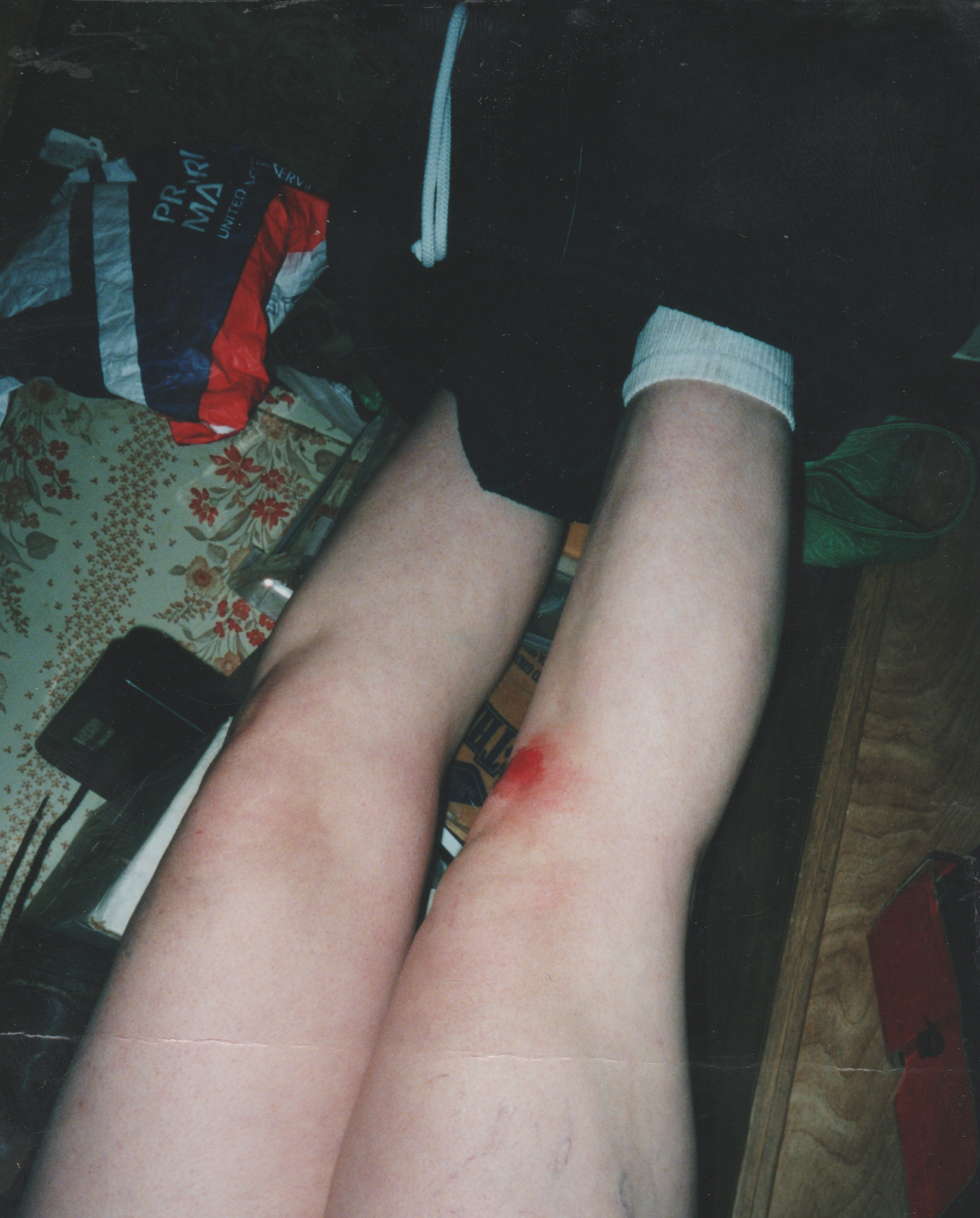 2001-12-06 - Legs Injured - Wound - Maybe Katie.jpg