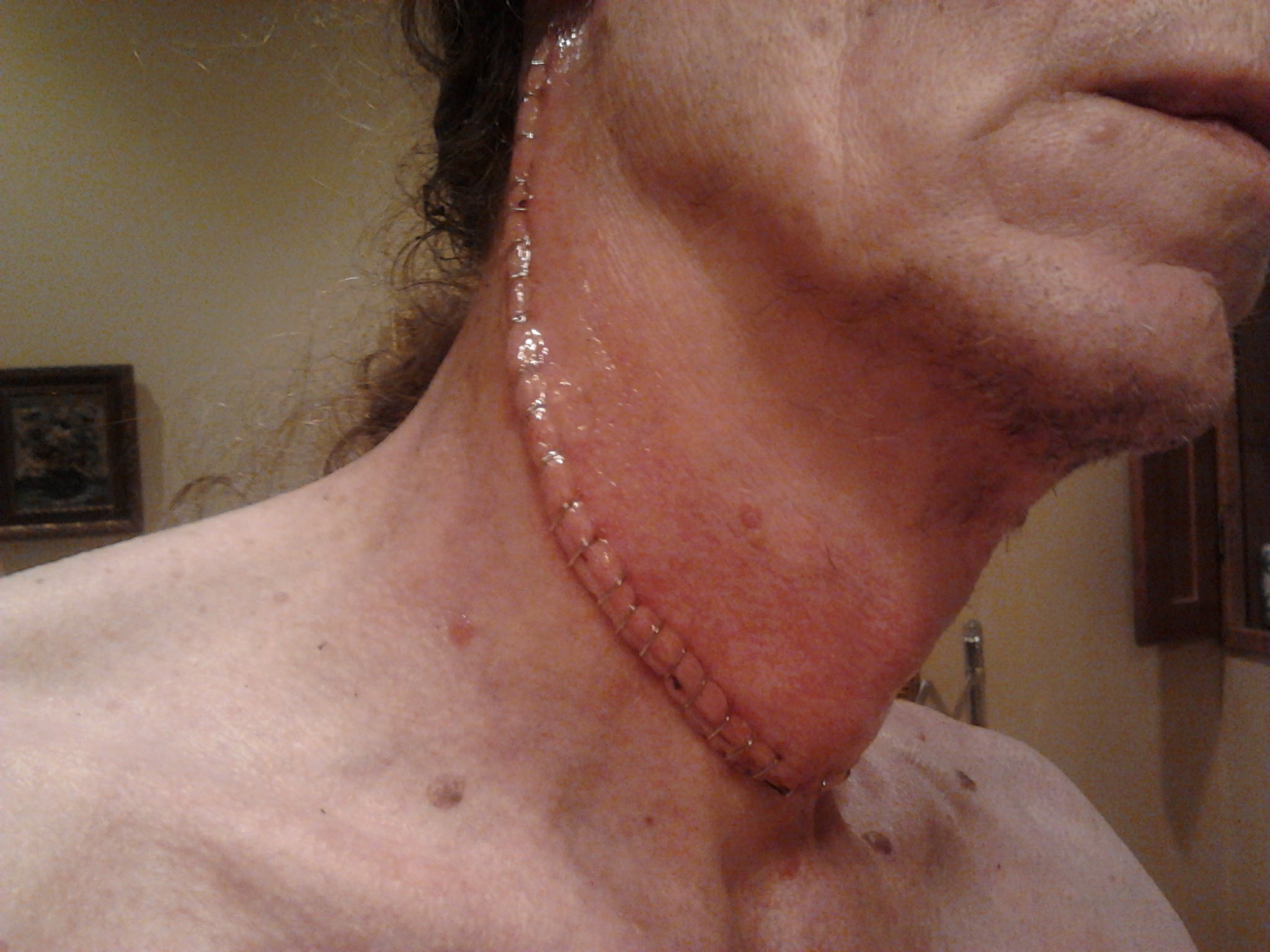 neck-staples.jpg