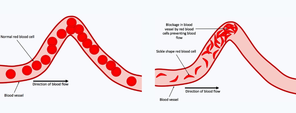 Sickle_Cell_Anaemia_red_blood_cells_in_blood_vessels_1.png