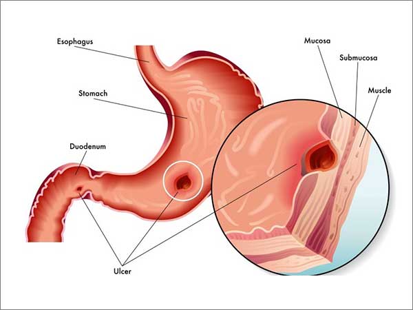 Peptic-Ulcer-Disease.jpg