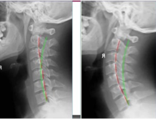 rectificación+cervical.png