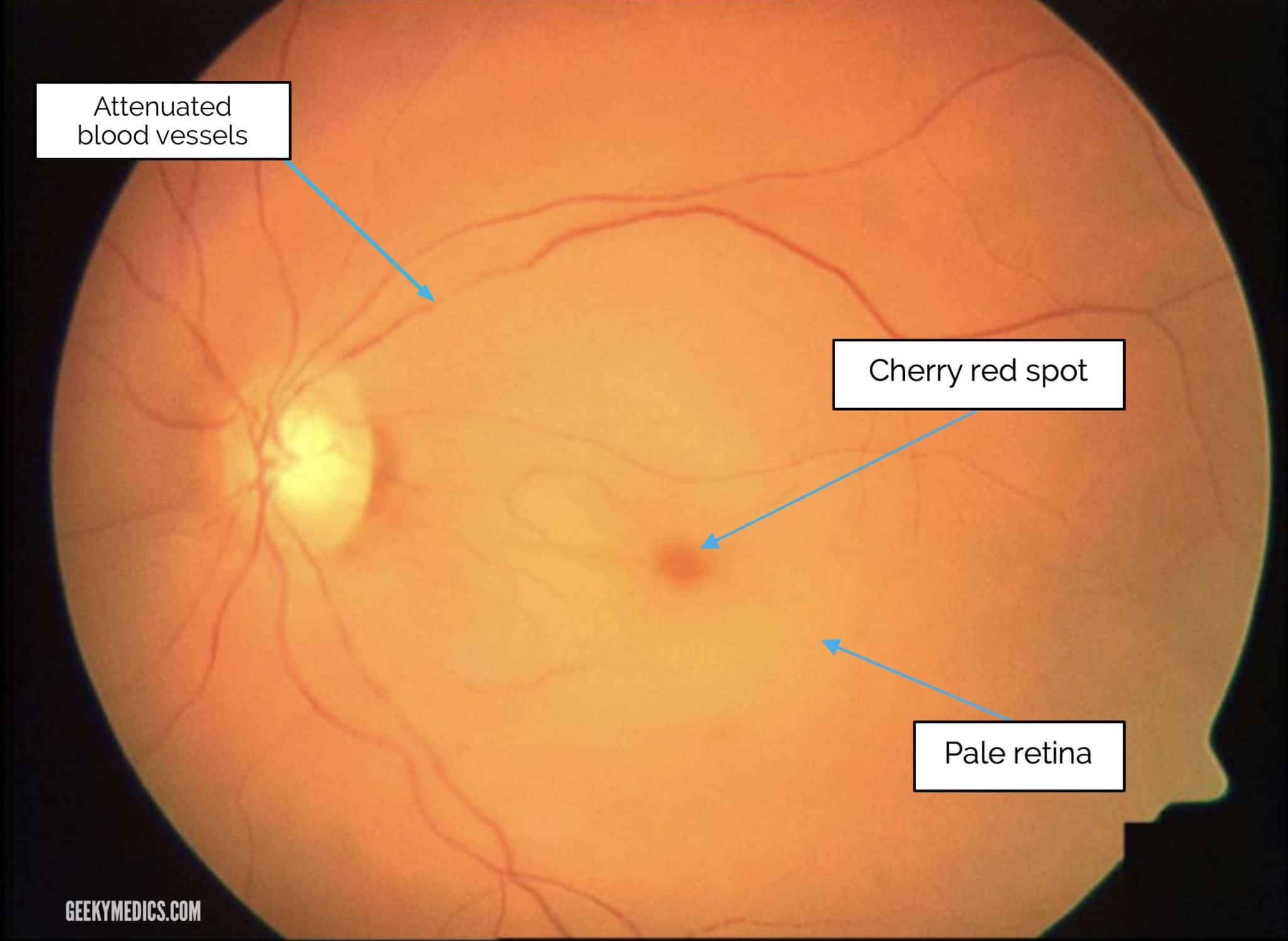 Cherry-red-spot-Pale-Retina-Central-Retinal-Artery-Occlusion-1-scaled.jpg