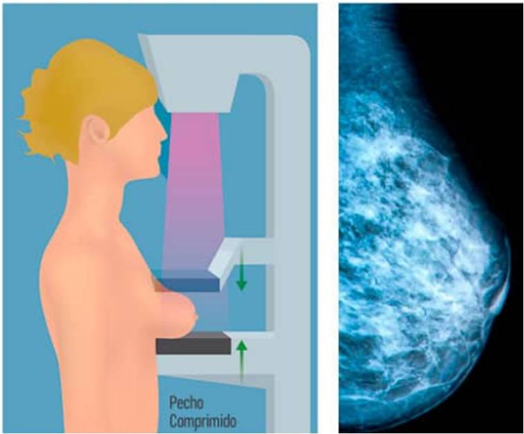 mamografia.jpg