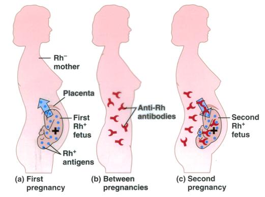 Rh-D-Isoimmunization-intranet.tdmu_.edu_.ua_.jpg