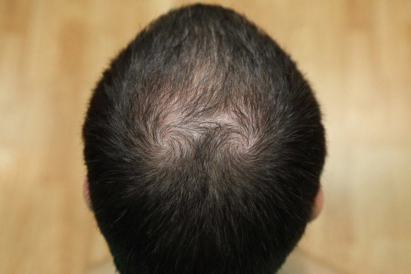 alopecia.jpg